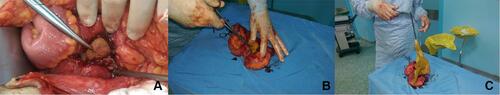 Figure 2 (A–C) Intraoperative laparotomy and sponge extraction.