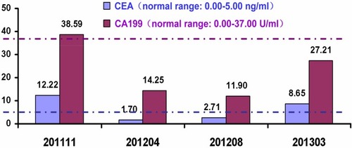 Figure 3 Follow-up with monitoring CEA and CA199. CEA seemed more sensitive than CA199 in this case.