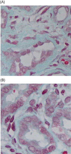 Figure 8. Masson staining (blue represents the collagen deposition). (A) In negative control group, renal interstitial fibrosis significantly increased, with renal interstitium widening and obvious collagen deposition. (B) In silence group, interstitial fibrosis was slighter with less collagen deposition. Original magnification 400×.