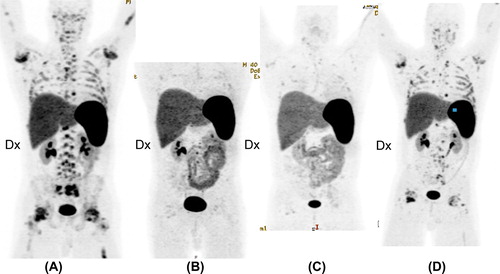 Figure 2. [18F]-fluorothymidine positron emission tomography (FLT PET) response. Four repeated FLT PET/CT scans in coronal view before (Figure 2A), and 2 weeks (Figure 2B), 2 months (Figure 2C) and 5 months (Figure 2D) after the start of vismodegib treatment. The uptake of FLT in the bone marrow is heterogeneous in Figure 2A. The spleen is enlarged and FLT uptake is intense. Figure 2B and C show a considerable reduction in FLT activity in bone marrow. The spleen is still enlarged with a high FLT uptake. A slight increase in the uptake can be seen in Figure 2D, heterogeneously distributed in the ribs, proximal humeri and femora. Uptake remains low in the spine. The sizes of the liver and spleen have decreased.