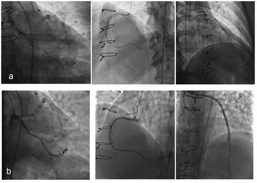 Figure 1. Coronary angiography was performed using 24 cc of undiluted Gadodiamide with a power injector. The patient’s coronary artery disease was essentially unchanged from her prior angiogram