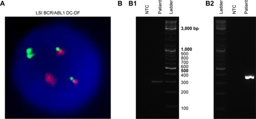 Figure 2 Cytogenetic (A) and molecular (B) analyses of Ph+ ALL patient’s bone marrow sample.