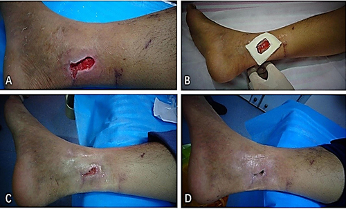 Figure 3 The dynamic process of platelet-rich plasma (PRP) treatment. (A) The cleaning and assessment of the wound. (B) The schematic representation of the PRP treatment. (C) The schematic representation of the wound closure process. (D) The wound was completely closure.