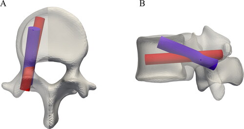 Figure 4. Example of a standard planned pedicle screw position in red vs. the resulting position from the GA method in blue for a L4 vertebra.