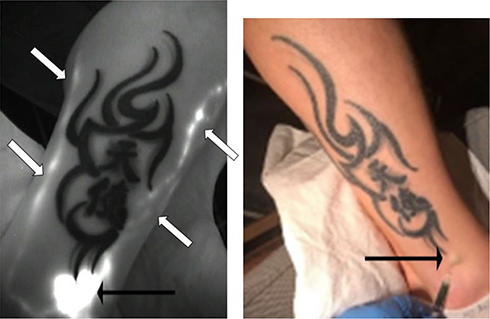 Figure 4 Abnormality type 5. The NIRFI figure (left sided) show lymphatic vessels (white arrows=subject j10) not running under the tattoo (at the level of the external and lower part of the right calf; black arrows show the ICG injected site) but seeming to bypass an obstacle and skirting the tattooed territory instead of crossing it.