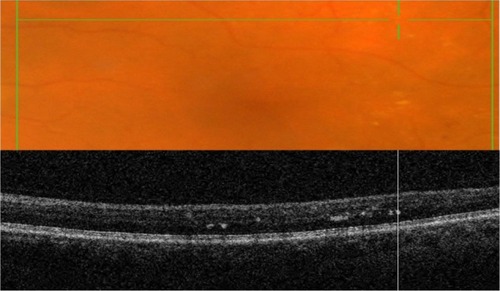 Figure 6 Cross-section of a scanned fundus image (top); the B-scan line on the fundus photograph has the same width as the B-scan SD-OCT image (bottom).