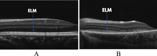 Figure 2. A nine-year-old patient with STGD1 (A) with an observable thickening of the ELM compared to an age-matched control (B). STGD1 image courtesy of Dr Jonathan Ruddle, Melbourne Children’s Eye Clinic. Control image provided by Dr Marianne Coleman from the Australian College of Optometry.