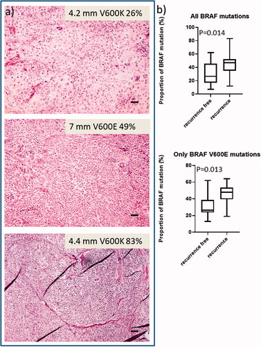 Figure 2. Representative hematoxylin-eosin slides of ulcerated primary CMMs showing the proportion of tumour cell content in relation to proportion of BRAF mutated alleles (a). Box plots demonstrate the distribution of proportion of all BRAF mutated alleles (recurrence free n = 16; recurrence n = 19) and BRAF V600E only (recurrence free n = 10; recurrence n = 13), with no respect to BRAF wildtype samples and not either to non-BRAF V600E in the bottom graph. There is a statistically significant difference in the distribution between patients who had recurrence and those who were recurrence-free (b). (t-test p = 0.014 and p = 0.013 respectively). Scale bar = 250 µm.