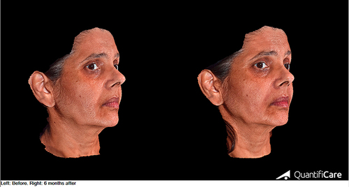 Figure 1 3D photographs of a 53-year-old female before (left) and six months after (right) nasolabial fold injection with HA filler. Photographs were taken with the LifeViz Mini 3D camera (Quantificare, USA).