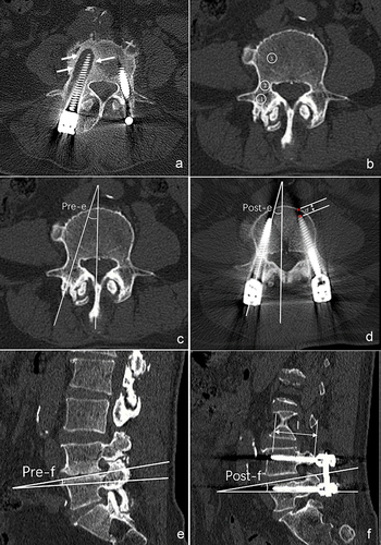 Figure 1 (a) Typical postoperative CT axial image of screw loosening. A radiolucent area encircling pedicle screws with sclerotic bone perimeter indicating screw loosening (white arrow) (b) Techniques for assessing preoperative CT HU The axial image of the corresponding pedicle was used to measure the HU of screw entry point area (ROI 1), pedicle (ROI 2) and vertebral body (ROI 3) excluding cortical bone. (c) The axial angle of the optimal screw trajectory in the preoperative CT (pre-e), namely angle between pedicle and sagittal plane of vertebral body. (d) The axial angle of the screw in postoperative CT (post-e), d is the distance between the screw tip and the anterior edge of the vertebral body (rad point). (e) The sagittal angle of the optimal screw trajectory in the preoperative CT (pre-f). (f) The sagittal angle of screw in postoperative CT (post-f). Reconstruction of the sagittal position along the screw, and measurement of the intraosseous length (l).