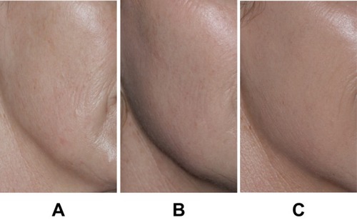 Figure 4 Representative images of cheek (A) before treatment, (B) 1 month after initial injection of VYC-12L, 0.5 mL per side, and (C) 2 weeks after second treatment with VYC-12L, 0.5 mL per side. Images courtesy of Izolda Heydenrych, MD.