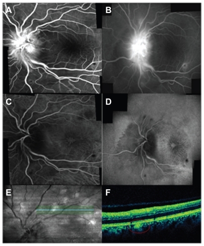 Figure 3 (A and B) Left eye: early (20° magnification) and late-phase of fluorescein angiograms showing leakage of optic disc, stellate maculopathy, and the retinal lesions revealing early blockage and late staining; (C and D) early (20° magnification) and late-phase of indocyanine green angiograms confirming a macular star and revealing early and late blockage in the same lesions observed on FA; (E and F) red-free and optical coherence tomography scan showing a focal increased reflectance at the retinal pigmented epithelium–choriocapillaris complex corresponding to the lesions (red circle).