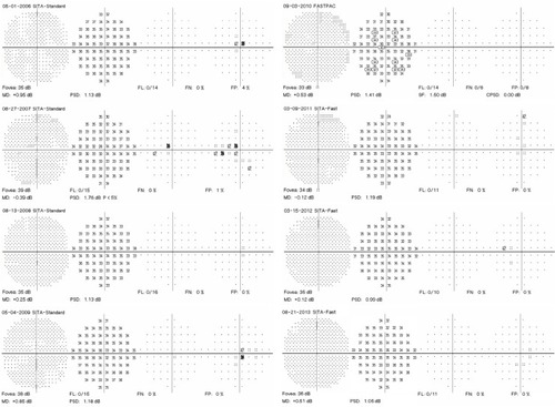 Figure 1 Eight consecutive 10-2 visual fields with a white target in a patient taking hydroxychloroquine without retinopathy.