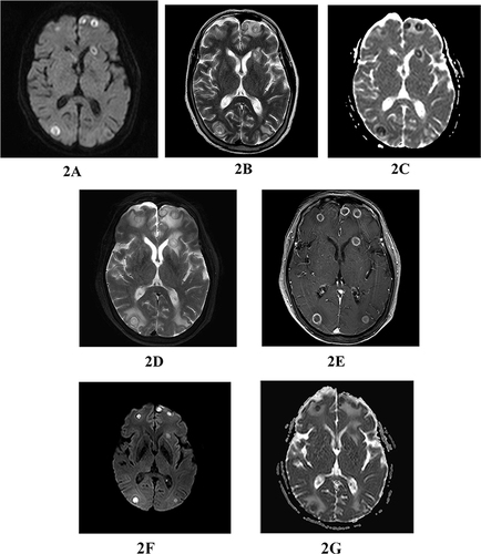 Figure 2 MR enhancement on June 6: Multiple ring-enhancing lesions were observed in bilateral cerebral and cerebellar hemispheres, along with perifocal edema and a uniform and smooth lesion ring wall. Pseudocontinuous arterial spin labeling (pCASL) and dynamic susceptibility contrast-enhanced perfusion-weighted imaging (DSC-PWI) demonstrated that the ring-enhancing lesions (solid portion) were hypoperfused, whereas diffusion-weighted imaging (DWI) demonstrated that diffusion was not obviously restricted, with most of the necrotic and liquefied areas within the lesion being significantly restricted in diffusion. Magnetic resonance spectroscopy (MRS) revealed a prominent lip peak in the lesion, along with diminished NAA, Cr, and Cho peaks, particularly the NAA and Cr peaks. (A) DWI sequence shows multiple nodular lesions in bilateral cerebral hemispheres, with low signal in the center of the lesion and high signal around it. (B) T2 sequence shows multiple nodular lesions in bilateral cerebral hemispheres with peripheral edema. (C) ADC sequence showed multiple nodular lesions in bilateral cerebral hemispheres, with high signal in the center of the lesion and low signal around it. (D) T2 sequence shows multiple nodular lesions in both cerebral hemispheres. (E) T1 enhanced scans showed multiple nodular lesions in both cerebral hemispheres, with ring-enhancement. (F) Multiple nodular high signal lesions in bilateral cerebral hemispheres of DWI sequence. (G) The ADC shows multiple nodular lesions in both cerebral hemispheres with low signal and restricted diffusion.