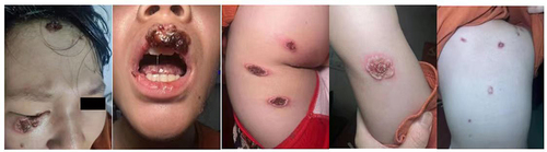 Figure 1 Clinical photograph of the patient - Initial photo.