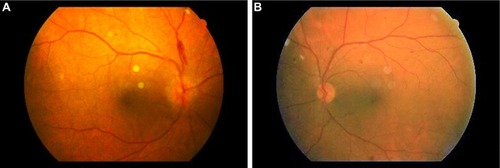 Figure 1 Fundus photographs of the patient.