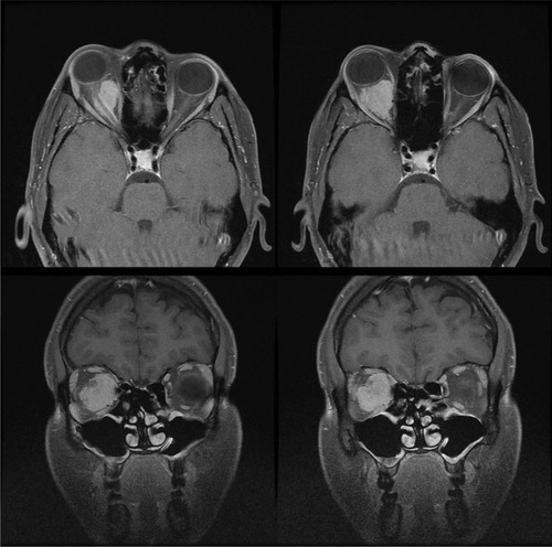 Figure 2 A large exophytic globular optic nerve sheath meningioma demonstrated on gadolinium contrast-enhanced T1-weighted fat suppressed magnetic resonance imaging.