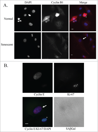 Figure 4. Cyclin expression in senescent glioblastoma cells. (A) Representative images of untreated normal and senescent (by morphology) U87MG cells. Immunofluorescence staining of Cyclin B1 (red) and nuclei are stained with DAPI (blue). Senescent cell of interest is shown using an arrow and the normal cell undergoing metaphase is shown using an asterisk. Scale bar = 10 μm. (B) Immunofluorescence staining of Cyclin E (red) and Ki-67 (green) in an untreated U87MG normal (asterisk) and senescent (arrow) cell. Nuclei are stained with DAPI (blue) and a brightfield grayscale image of SAβGal is on the bottom right. Scale bar = 10 μm.