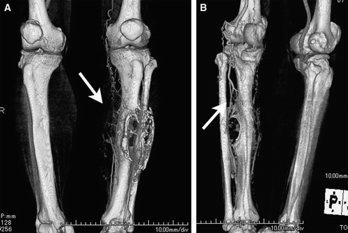Figure 5.  Volume-rendered image extracting only the images of bone and vessels showed many branches from the tibialis posterior artery and peroneal artery around the bone defect.