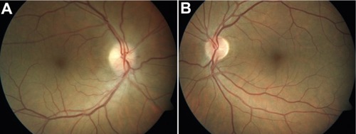 Figure 1 (A) Fundus photograph of the right eye shows swelling of the disc and disc rim hemorrhage (left). (B) Fundus photograph of the left eye shows a healthy appearing but crowded disc with a cup-to-disc ratio of 0.2 (right).