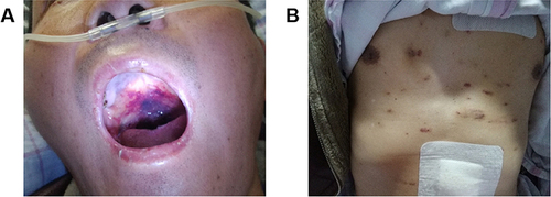 Figure 1 The observation and physical examination of disseminated AIDS-KS. (A) Purple-red macula on the oral mucosa. (B) Dark red maculopapular on chest and abdomen skin.