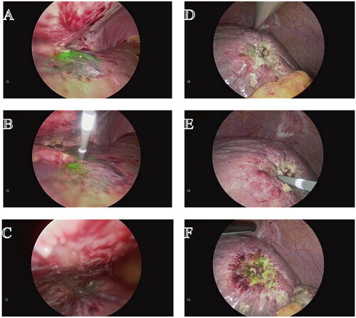 Figure 3. ICG fluorescence remained after ultrasound-guided ablation (Case 26). (A) Tumor imaging with ICG fluorescence imaging after ultrasound-guided percutaneous ablation (B) Inserting the needle to ablate the tumor at the edge with ICG green fluorescence. (C) Tumor fluorescence imaging after complete ablation (D) Residual fluorescence was found in tumors after ultrasound-guided microwave ablation. (E) FLWMA were performed to ablate tumor with the residue green fluorescence. (F) The green fluorescence was still presented in the tumor after FLMWA.