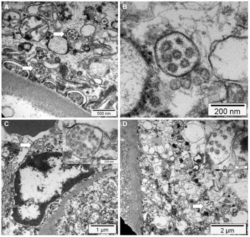 Figure 5. Electron microscopy findings. (A) Transmission electron micrograph of kidney section showing virus-like particles (sizes between 70 nm and 110 nm) within podocyte cytoplasm (arrow). (B) The vesicles contain virus‐like particles with a ring of electron‐dense granules. (C) Virus‐like particles (arrow and insert) within a vesicle that is close to the luminal border. (D) Cytoplasm of a proximal tubular epithelial cell with vesicle containing virus‐like particles (arrow and insert). Reproduced from Menter et al. (Citation2020) under Creative Commons Attribution (CC BY) licence.