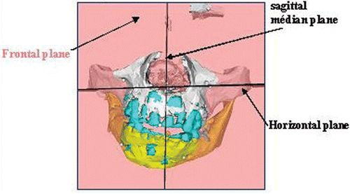 Figure 3. Three-dimensional cephalometric analysis as proposed for determining the distraction vector. [Color version available online.]
