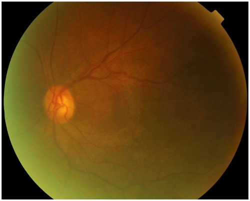 Figure 1 An image of the fundus on initial presentation in case 4. The epiretinal membrane is evident over the macula.