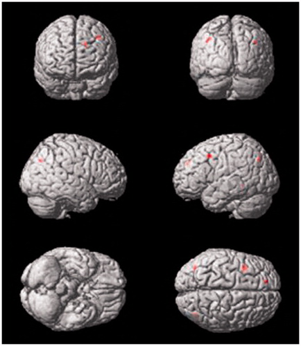 Figure 2. Brain areas of negative correlation in the high maternal care group as anxiety levels increase (superior and middle frontal gyrus). The same group has a negative correlation in the precuneus, independent of anxiety scores. For a detailed description, see Table 1 Contrast of palatable foods > neutral items. Student’s t-test, FWE was corrected for multiple comparisons, p < 0.05.