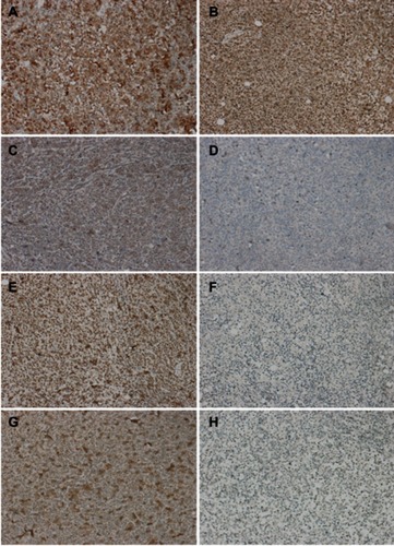 Figure 18 Immunohistochemical staining of tumor signaling pathway protein (A is the control group BCR-ABL, B is the experiment group, in which BCR-ABL was strongly positive; C was the control group, in which P-AKT was moderately positive; D was the treatment group, in which P-AKT was weakly positive; E was the control group, in which P-mTOR was strongly positive, and F was the treatment group in which P-mTOR was weakly positive; G was a control group, in which P-S6K was strongly positive, and H was a treatment group, in which P-S6K was weakly positive; ×200).