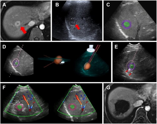 Figure 3. A 37-year-old female with hepatocellular carcinoma in segment VIII of liver. (A) Preoperative MRI scan showed one HCC lesion in segment VIII with the diameter measured to be 2.3 cm. (B) On baseline ultrasound, the lesion appeared hypoechoic with clear boundary and regular morphology. (C) After acquisition of 3DUS volume data and reconstruction, the tumor was automatically segmented and labeled in green color, and an ablative margin of 5 mm was displayed around the tumor in purple color. (D) Two ablation needles were planned to be placed, and the simulative ablation zone had covered the tumor and ablative margin completely through assessment in different plane. (E) Puncture of ablation needles according to the plan. The tips of ablation needles were shown by red arrows. (F) When ablation is done, the accuracy of registration of real-time 2DUS image (left) and 3DUS reconstructive image (right) were confirmed again. The tumor and ablative margin were completely covered by the hyperechoic ablation zone. (G) MRI at one month after ablation showed complete ablation of the tumor with ablative margin greater than 5 mm.