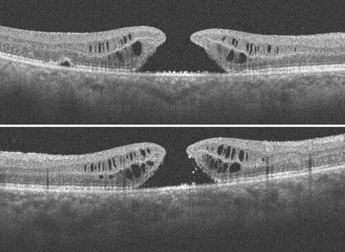 Figure 4 FTMH noticed one month after silicone oil removal; ERM and intraretinal fluid is present. Also present is a “bump” in the outer retinal layers (of uncertain significance) which may be due to tangential traction.