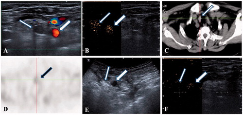 Figure 1. A 55-year-old female patient with a recurrent and ectopic SHPT nodule in the suprasternal fossa 3 years after parathyroidectomy that was treated by microwave ablation (MWA). (A) A hypoechoic nodule (thin arrow) without a blood signal beside the carotid artery (thick arrow) was disclosed by ultrasound. (B) A uniform hyper-enhancement of the nodule (thin arrow) beside the carotid artery (thick arrow) was displayed in CEUS pre-ablation. (C) The CT scan showed that the nodule is in the suprasternal fossa (thin arrow). (D) The nodule has radioactivity concentration (black arrow) in the late phase on MIBI scan. (E) The hyperechoic signal emerging inside the nodule (thin arrow) beside the carotid artery (thick arrow) during ablation. (F) A non-enhancement area covered the nodule (thin arrow) beside the carotid artery (thick arrow) after MWA, suggesting complete ablation was achieved by MWA.