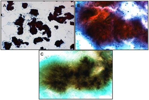 Figure 2 Brush cytology of granular discharge containing many actinomyces colonies (A) (Papanicolaou stain, object lens magnification 4×). (B) Magnified image of (A) (Papanicolaou stain, 40×) showing actinomyces strangles with abundant mycelia radiating outwards. (C) Gomori methenamine silver stain of (B) showing presence of blackish thin filamentous mycelia radiating outwards (40×).