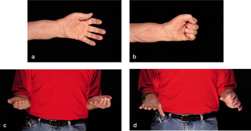 Figure 2. Functional results of the first US hand transplant recipient at the 5-year follow-up: a) extension, b) flexion, c) supination, and d) pronation.