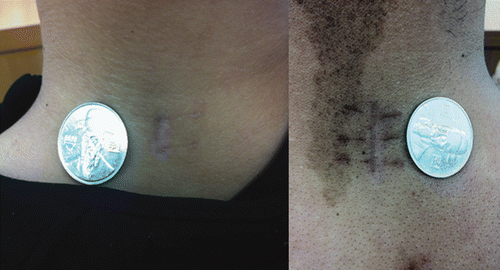 Figure 4. Left: A 1.6-cm skin incision for one-level decompression. Right: A 2.0-cm skin incision for two-level decompression.