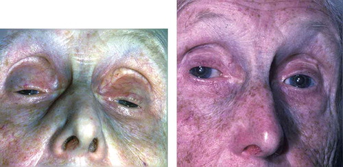 Figure 4. Progressive worsening of severe ptosis of 20 years enforcing head posture in a patient of 76, with suboptimal acceptable under correction. Left image: preoperative head posture – exposed nostrils. Right image: acceptable under correction despite 24 mm MT flap resection, suboptimal result from my over cautiousness and brief timidity, the MT flap excision should have been 26 mm. No further surgery needed, as the visual axis is clear without CHP.With acknowledgements to PostScript Media Pvt Ltd.