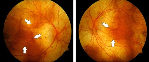 Figure 1 Fundus color photographs of the right and left eye of a patient with advanced choroideremia.
