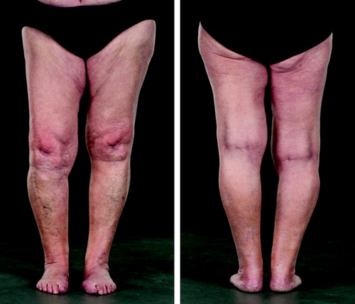 Figure 2 a. Pictures at 65 years of follow-up (patient age 78 years), showing slight varus deformity of the right leg.
