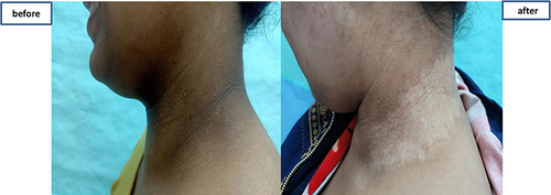 Figure 8 Hypopigmentation following Q-switched laser application occurred in one patient.