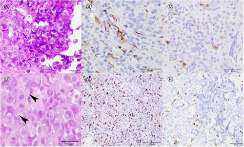 Figure 2. Histologic examination showing an undifferentiated malignant embryonal neoplasm comprised of large pale epithelioid cells with prominent nucleoli (A, H&E 600×). Neoplastic cells showing polyimmunophenotypic protein expression with focal GFAP staining (B, 400×) and focal EMA staining (C, 400×). Malignant cells have occasional characteristic rhabdoid cytologic features with eccentric nuclei and dense eosinophilic fibrillary inclusions (D, arrowheads, 600×). The ki67 proliferative index was ∼70% (E, 200×). Staining for INI-1 protein showing loss of nuclear immunoreactivity in malignant cells indicating inactivation of SMARCB1 (F, 400×).