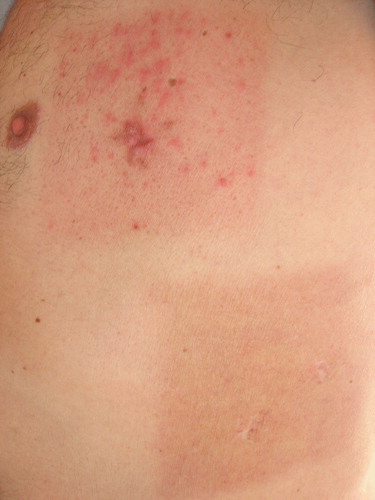 Figure 1.  Erythematous rash was only seen in the recently irradiated field.
