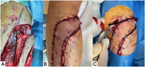 Figure 4. Clinical course throughout the 3 d after flap elevation. (A) The proximal pedicle was clamped with a vascular clip. (B) After 3 h, the flap was clearly congested. (C) Immediately after removing clips, the color tone of the flap normalized.