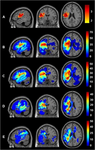 Figure 5. Comparison of lesion sites across the four different groups. Lesion site results after assigning the 143 patients to four groups according to initial severity (Severe versus Moderate) and the provision of therapy (Yes versus No). Top row (A) shows the brain regions where damage was significantly greater in those with Severe versus Moderate initial severity. The sagittal, coronal and axial slices are at the co-ordinates of the most significant group difference (−48, −2, +24). Rows B to E show the lesion overlap maps (showing the frequency of damage) for the four groups at the same co-ordinates. From top to bottom, B) Patients with Severe initial severity who received Therapy (n = 59); C) Patients with Severe initial severity who did not receive therapy (n = 49); D) Patients with Moderate initial severity who received Therapy (n = 20); E) Patients with Moderate initial severity who did not receive therapy (n = 15). The colour scale indicates percentage of patients for each group.
