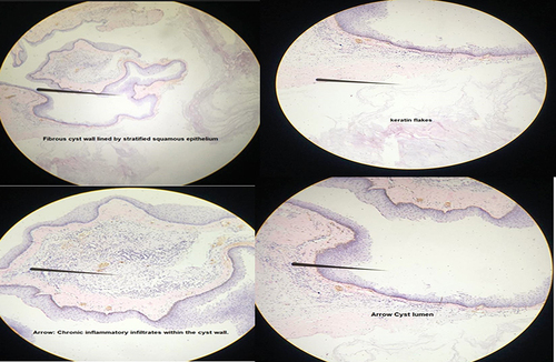 Figure 4 Histopathology microscopic pictures demonstrating keratin flakes, fibrous cyst wall lined by stratified squamous epithelium, chronic inflammatory infiltrates within the cyst wall and a cyst lumen.