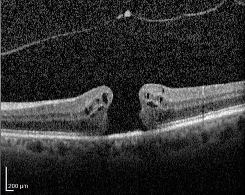 Figure 1 Preoperative optical coherence tomography showing full-thickness macular hole.