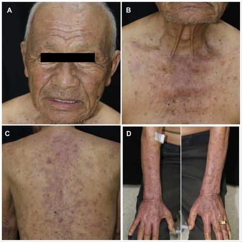 Figure 3 One month after Durvalumab was discontinued, the lesions resolved with post inflammatory hyperpigmentation on face (A), upper chest (B), back (C), and dorsum of both forearms (D).