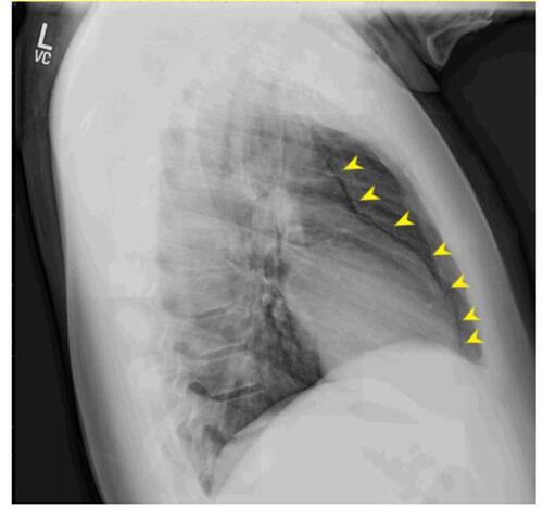 Figure 2 Chest X-ray (lateral view) demonstrating lucency (Yellow arrows) overlying the heart signifying pneumopericardium.