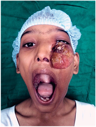 Figure 1. ANP presenting as a large exophytic mass, left nasal polyp extending posteriorly into the oropharynx too. *Picture used after patient and relatives consent.